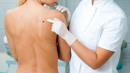pinta-melanoma